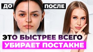Изменили в уходе ЭТО и ПОСТАКНЕ УШЛО! Пошаговый план как убрать рубцы и высыпания дома
