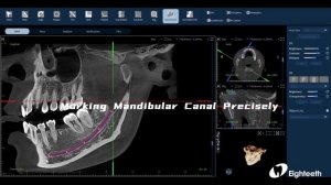 Eighteeth FinScan F350 — Software 3D Video