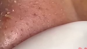 #203 Чистка лица от угрей и акне. Выдавливание прыщей. Удаление черных точек и комедонов