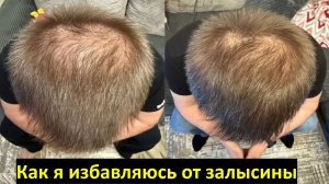 Как  избавиться от седины волос и лысины