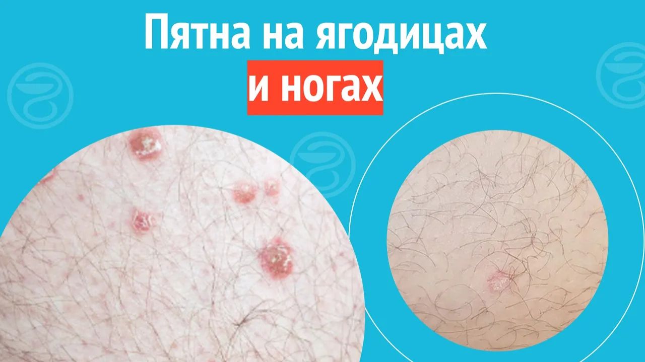 🦵 Пятна на ягодицах и ногах. Клинический случай №1433 смотреть онлайн