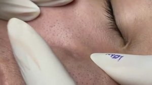 Профессиональное очищение как основа лечения acne.