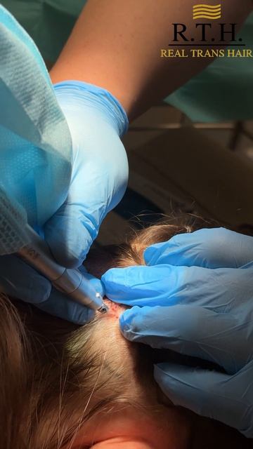 No‑Shave FUE! Пересадка волос без выбривания