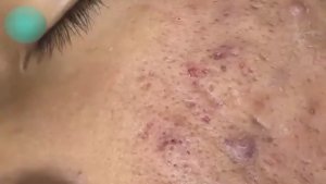 ЗАЛИПАТЕЛЬНАЯ ЧИСТКА: как мы работаем с акне и черными точками