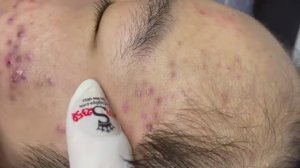 038 • Relax Spa • АСМР • Acne collection