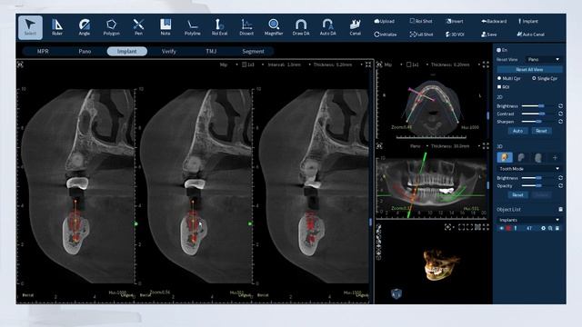 Eighteeth FinScan Workflow — Implant Planning смотреть онлайн