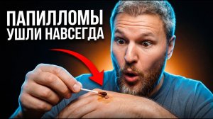 ПАПИЛЛОМЫ ОТВАЛИВАЮТСЯ НА ГЛАЗАХ: топ лучших способов