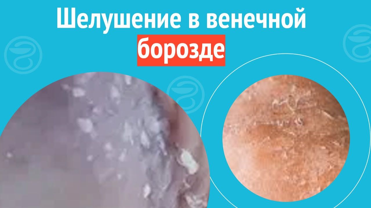 ▶️ Шелушение в венечной борозде. Клинический случай №1440 смотреть онлайн