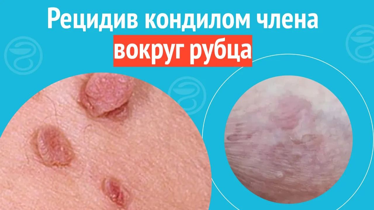 🥺 Рецидив кондилом члена вокруг рубца. Клинический случай №1426 смотреть онлайн