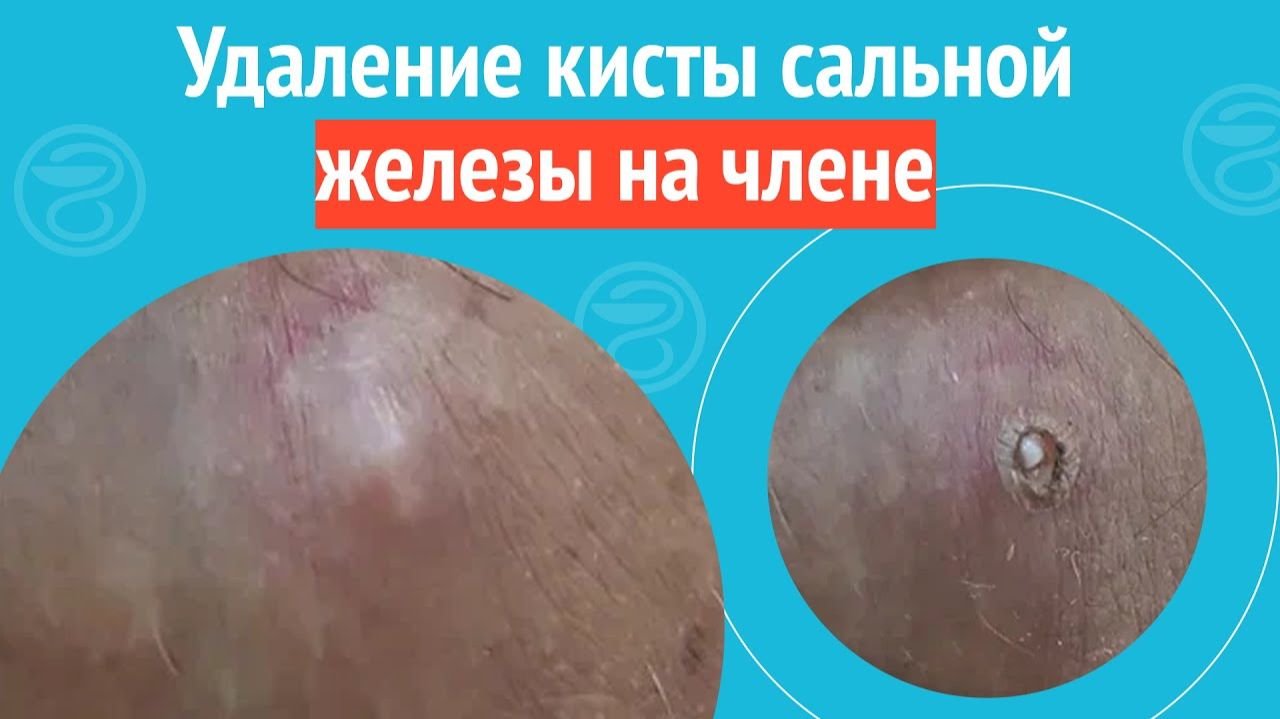 ✅ Удаление кисты сальной железы на члене. Клинический случай №1430 смотреть онлайн