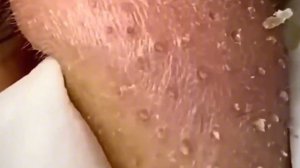 #202 Чистка лица от угрей и акне. Выдавливание прыщей. Удаление черных точек и комедонов