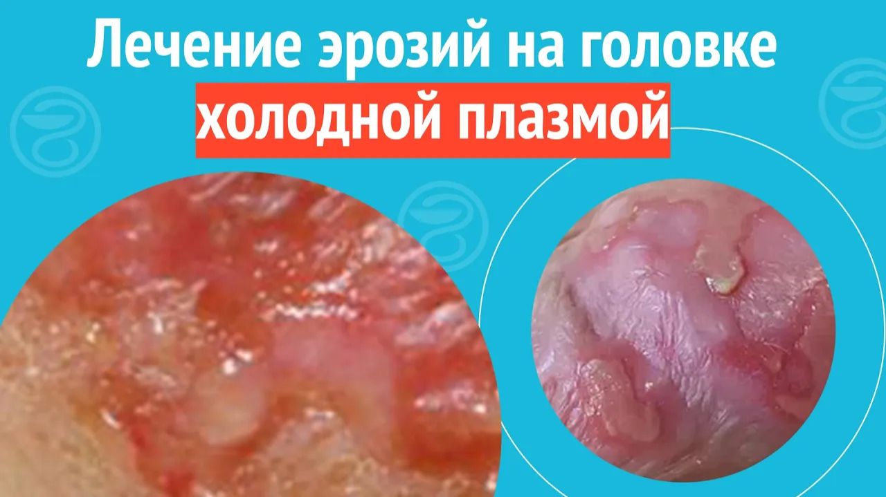 🩺 Лечение эрозий на головке холодной плазмой. Клинический случай №1434 смотреть онлайн