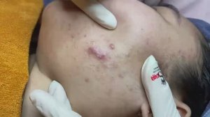 037 • Relax Spa • АСМР • Acne collection