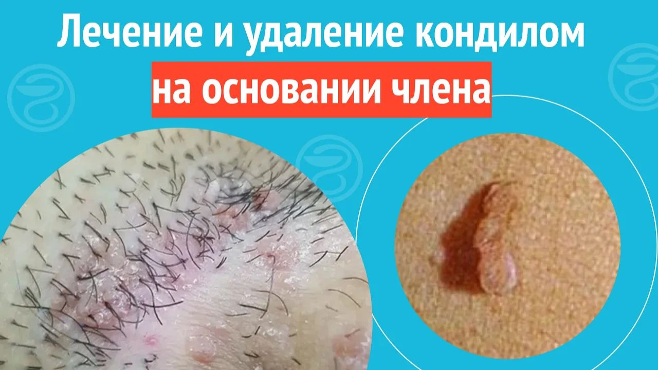 ✅ Лечение и удаление кондилом на основании члена. Клинический случай №1437 смотреть онлайн