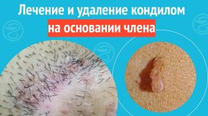 ✅ Лечение и удаление кондилом на основании члена. Клинический случай №1437