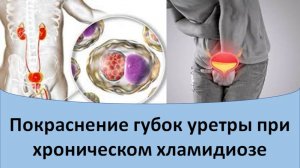 Покраснение губок уретры при хроническом хламидиозе