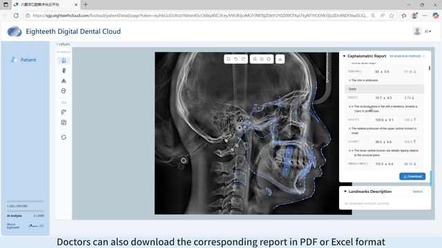 Eighteeth FinScan F350 — Cephalometric X-ray Analysis Report смотреть онлайн