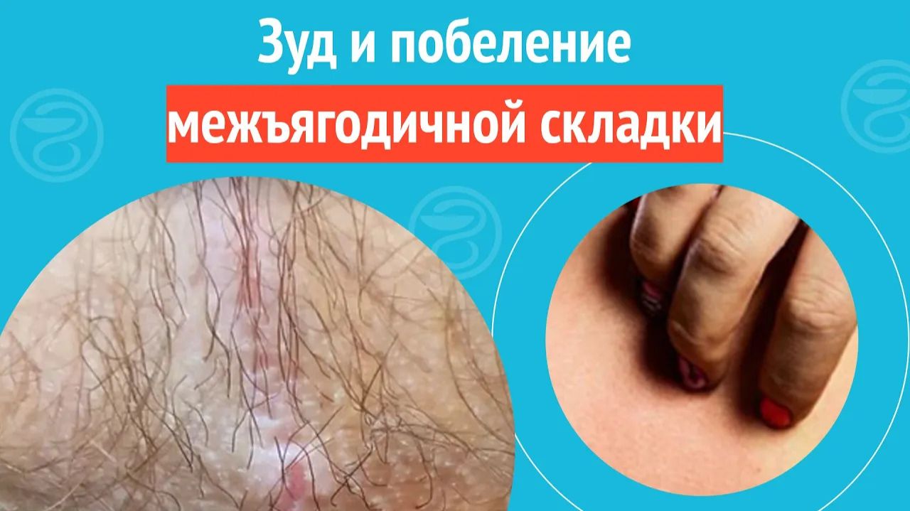 👉 Зуд и побеление межъягодичной складки. Клинический случай №1425