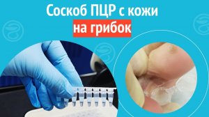 🧪 Соскоб ПЦР с кожи на грибок. Клинический случай №1486
