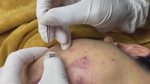 Подкожные и воспаленные прыщи со скоплением крови на коже