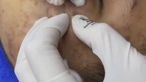 Глубокие подкожные прыщи. #чисткалица #механическаячистка