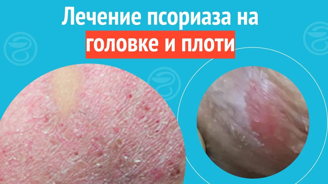 ✅ Лечение псориаза на головке и плоти. Клинический случай №1436 смотреть онлайн