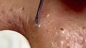 #206 Чистка лица от угрей и акне. Выдавливание прыщей. Удаление черных точек и комедонов