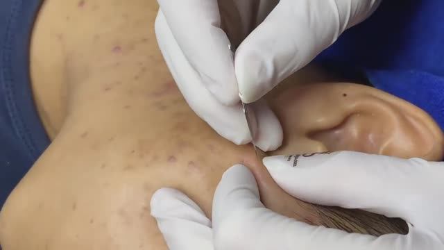 Прыщи вокруг шеи и области челюсти