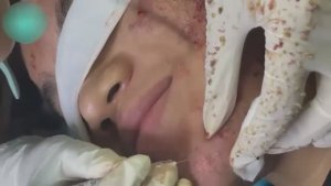 НЕ ПРОПУСТИ! Как мы делаем глубокую чистку лица от акне и комедонов