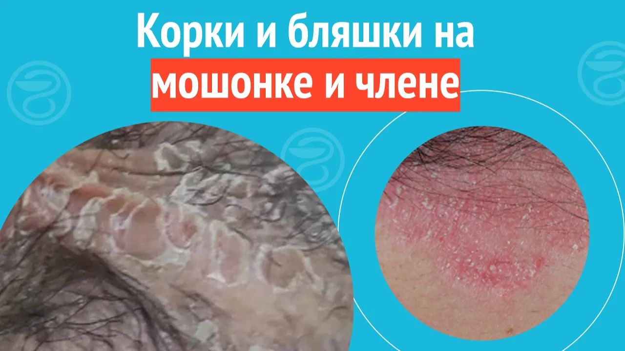 😯 Корки и бляшки на мошонке и члене. Клинический случай №1475 смотреть онлайн
