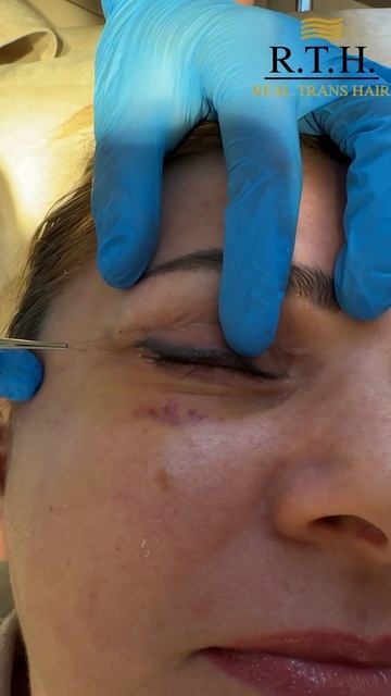 7 дней после блефаропластики. Снимаем швы, смотрим на рубцы!