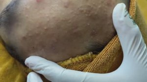 Удаление подкожных прыщей на лбу