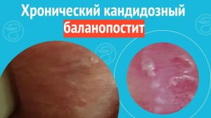 😢 Хронический кандидозный баланопостит. Клинический случай №1488