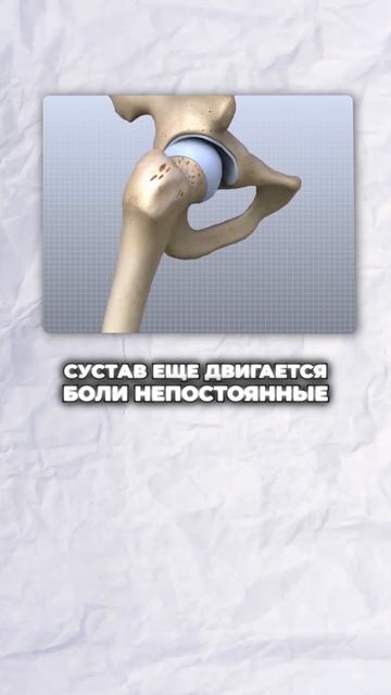 Хондропротекторы работают ТОЛЬКО если..