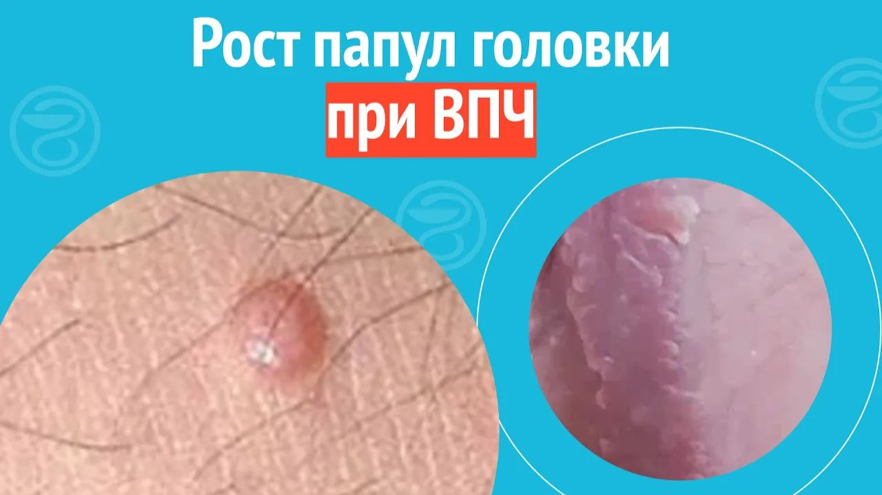 🖕 Рост папул головки при ВПЧ. Клинический случай №1471 смотреть онлайн