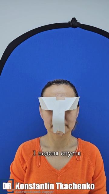 Отопластика — пластическая операция по коррекции формы, размера и расположения ушных раковин.