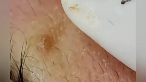 Выдавливание прыщей, угрей, черных точек и камедонов #306