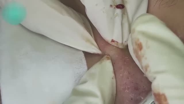 Лечение открытых и закрытых комедонов. Механический метод