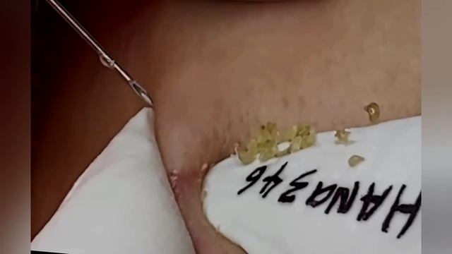 Выдавливание прыщей, угрей, черных точек и камедонов #302