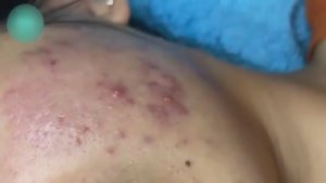 ИНТЕНСИВНАЯ ОЧИСТКА лица от угревой сыпи и акне