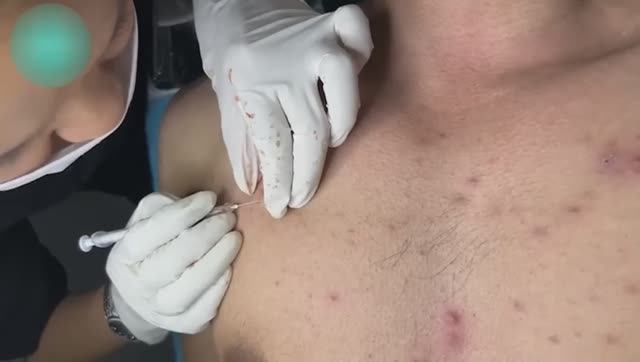 Удаление угрей и прыщей. Расслабляющий видеоролик. #прыщи #угри #угреваясыпь #удалениепрыщей