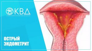 👩 1484  Острый эндометрит