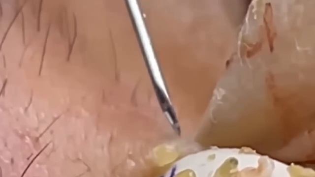 #207 Чистка лица от угрей и акне. Выдавливание прыщей. Удаление черных точек и комедонов