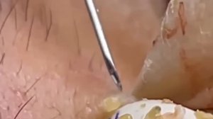 #207 Чистка лица от угрей и акне. Выдавливание прыщей. Удаление черных точек и комедонов