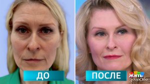 Глаза на 10 лет моложе: правда или косметический трюк? Жить здорово! Фрагмент выпуска от 27.03.2026