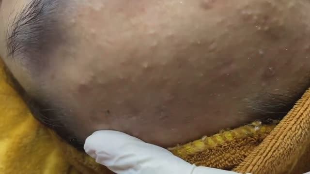 Удаление подкожных прыщей на лбу
