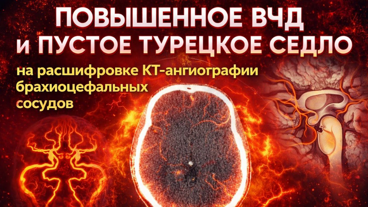 АНОМАЛИЯ Киммерли, ВНУТРИЧЕРЕПНОЕ ДАВЛЕНИЕ и пустое турецкое седло на РАСШИФРОВКЕ КТ ангиографии