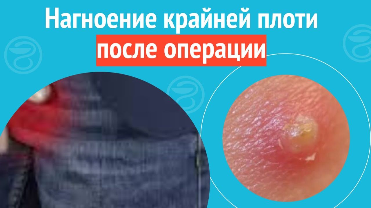 😲 Нагноение крайней плоти после операции. Клинический случай №1485 смотреть онлайн