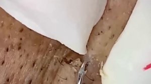 #205 Чистка лица от угрей и акне. Выдавливание прыщей. Удаление черных точек и комедонов