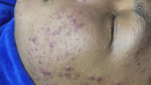 Лечение прыщей и темных пятен (пигментации)